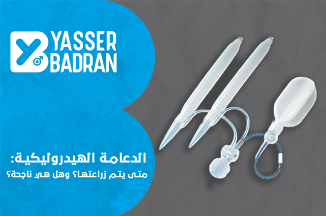 الدعامة الهيدروليكية: متى يتم زراعتها؟ وهل هي ناجحة؟