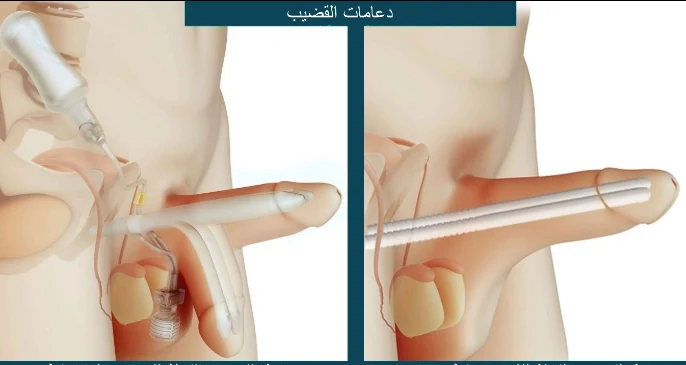 العملية الجراحية لتركيب دعامة للعضو الذكري