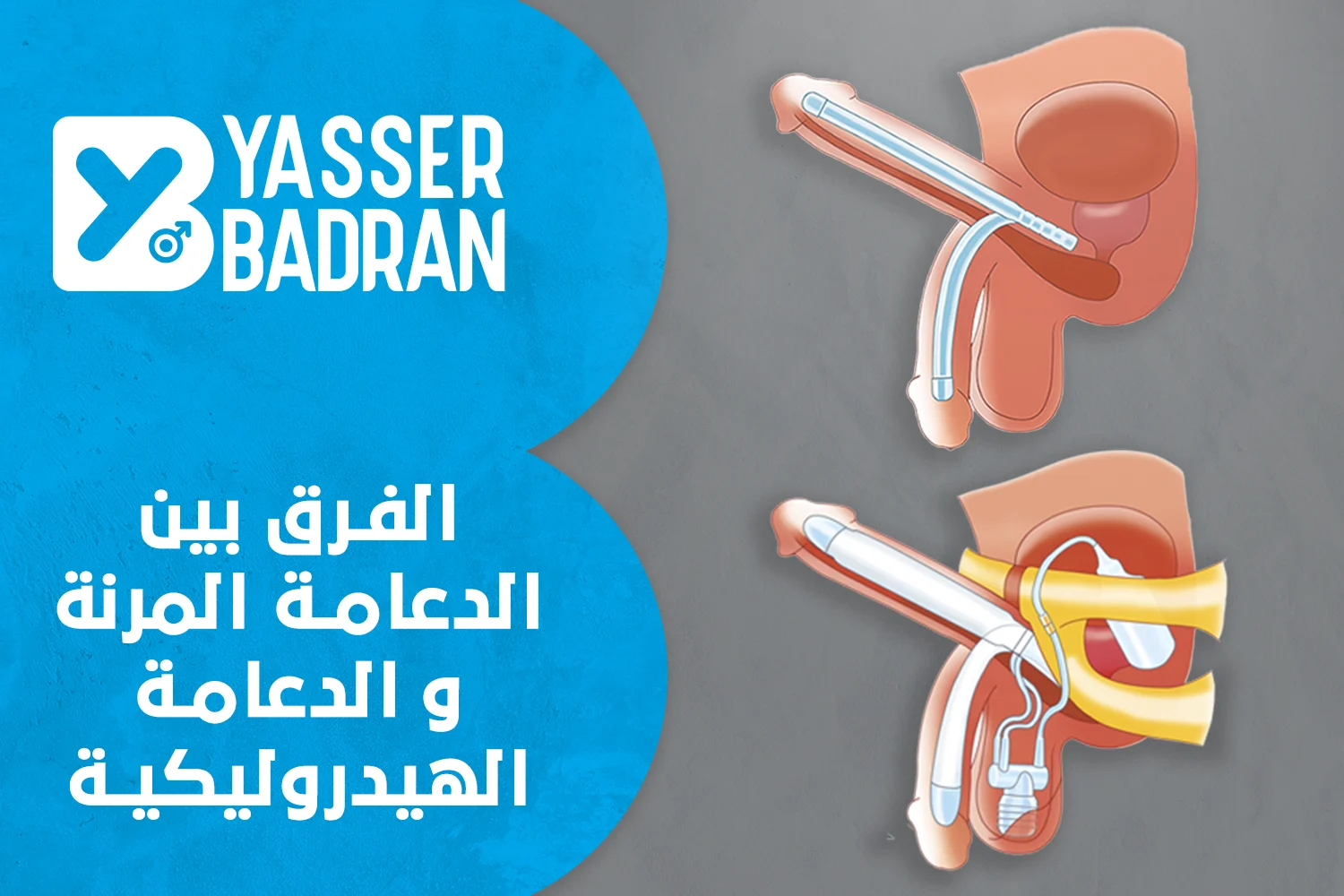 الفرق بين الدعامة المرنة والهيدروليكية بالتفصيل